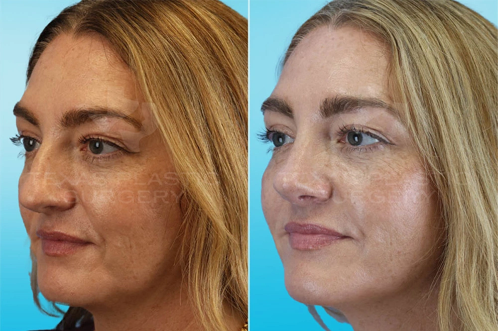 Real Patient results in San Antonio, TX Performed by Texas Plastic Surgery