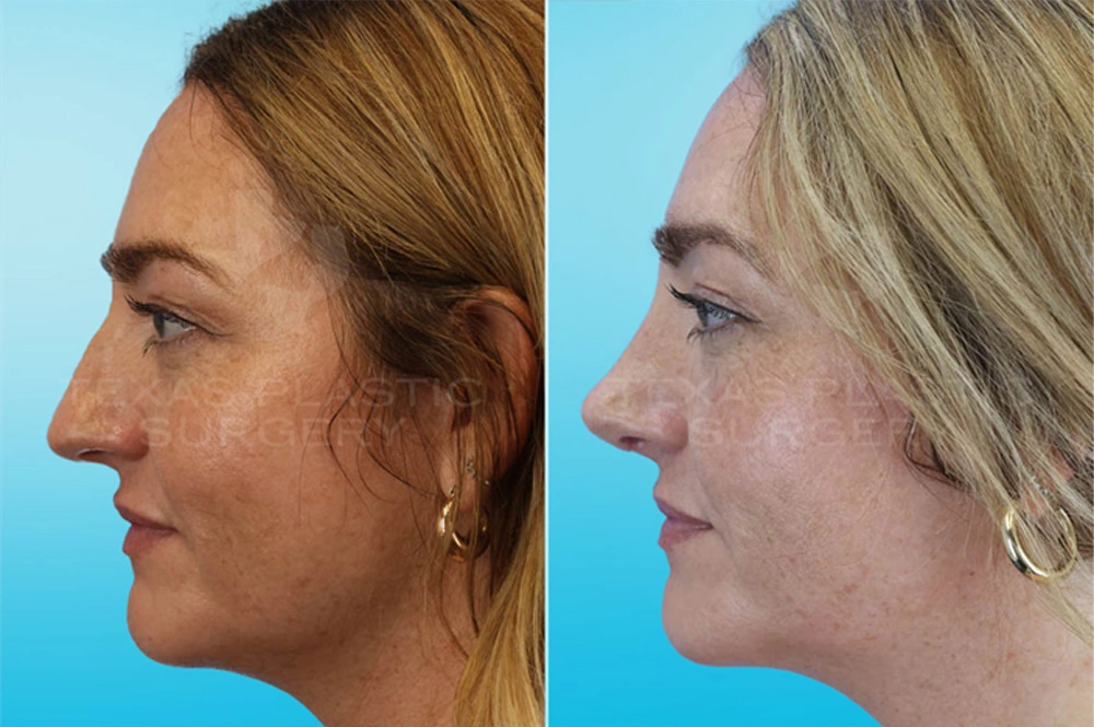 Real Patient results in San Antonio, TX Performed by Texas Plastic Surgery
