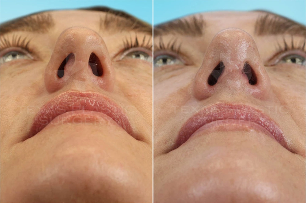 Real Patient results in San Antonio, TX Performed by Texas Plastic Surgery