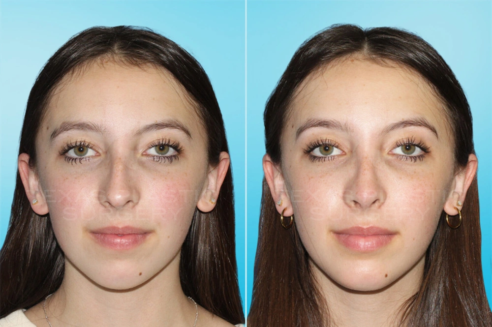 Real Patient results in San Antonio, TX Performed by Texas Plastic Surgery