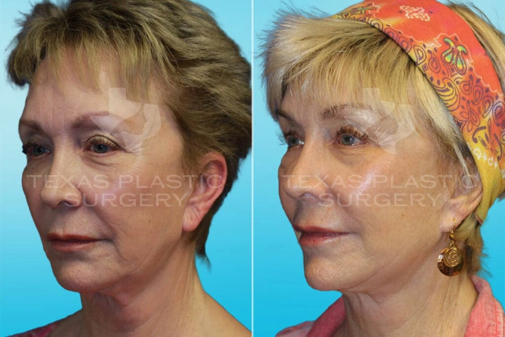 Real Patient results in San Antonio, TX Performed by Texas Plastic Surgery