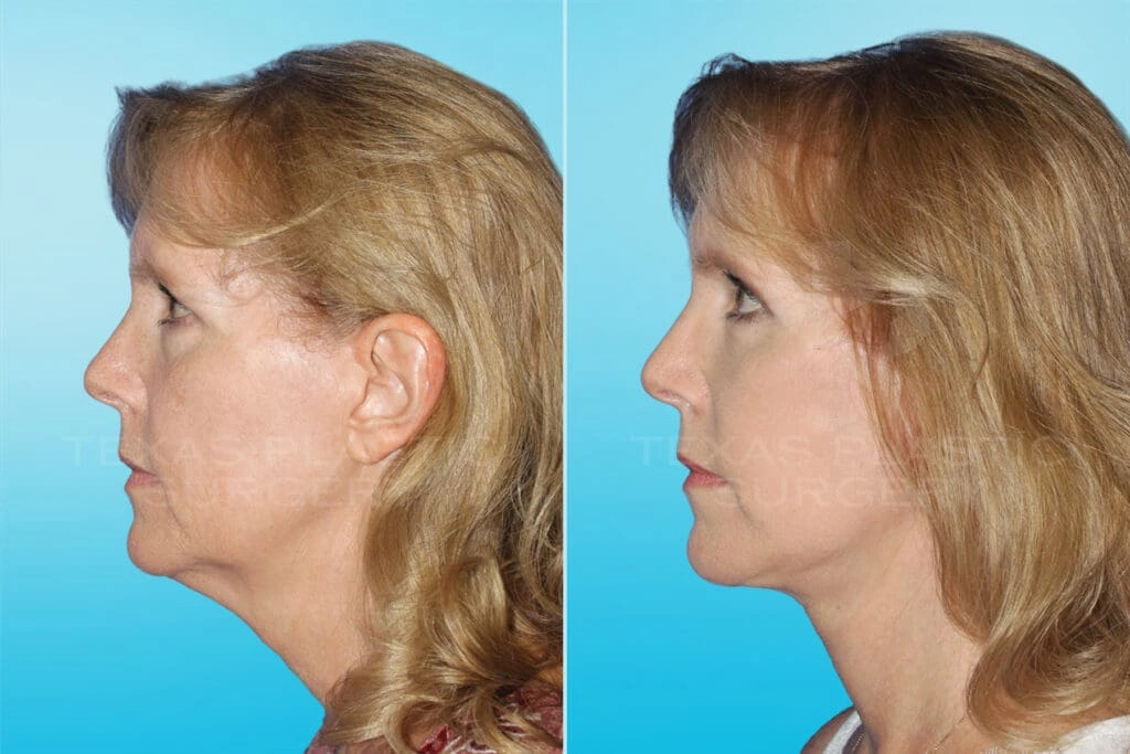 Real Patient results in San Antonio, TX Performed by Texas Plastic Surgery