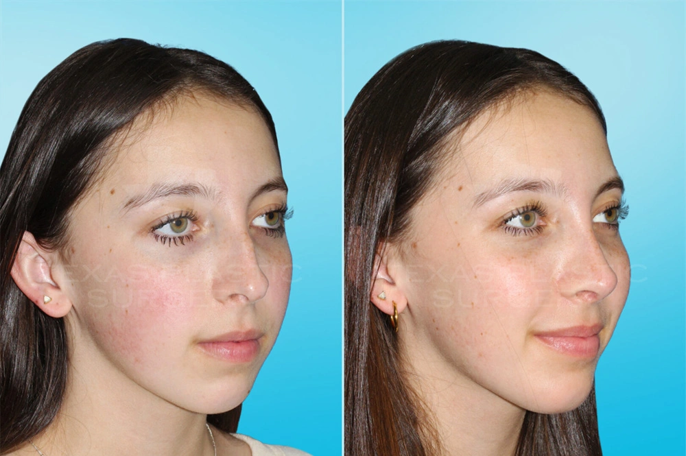 Real Patient results in San Antonio, TX Performed by Texas Plastic Surgery