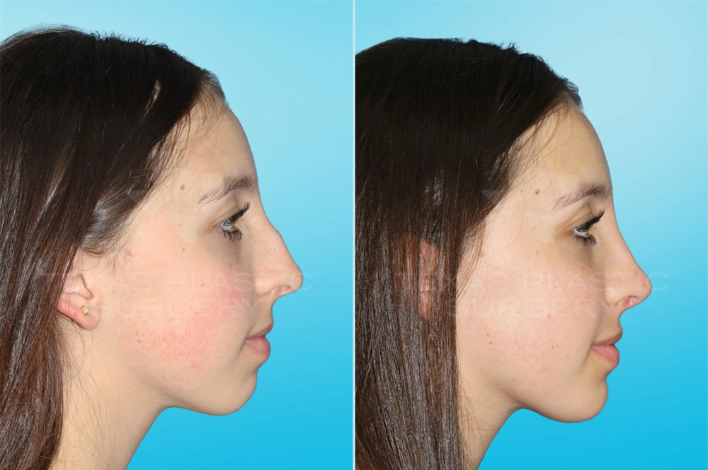 Real Patient results in San Antonio, TX Performed by Texas Plastic Surgery