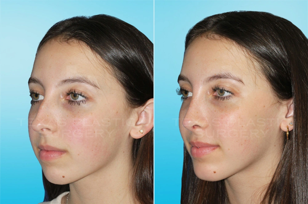 Real Patient results in San Antonio, TX Performed by Texas Plastic Surgery