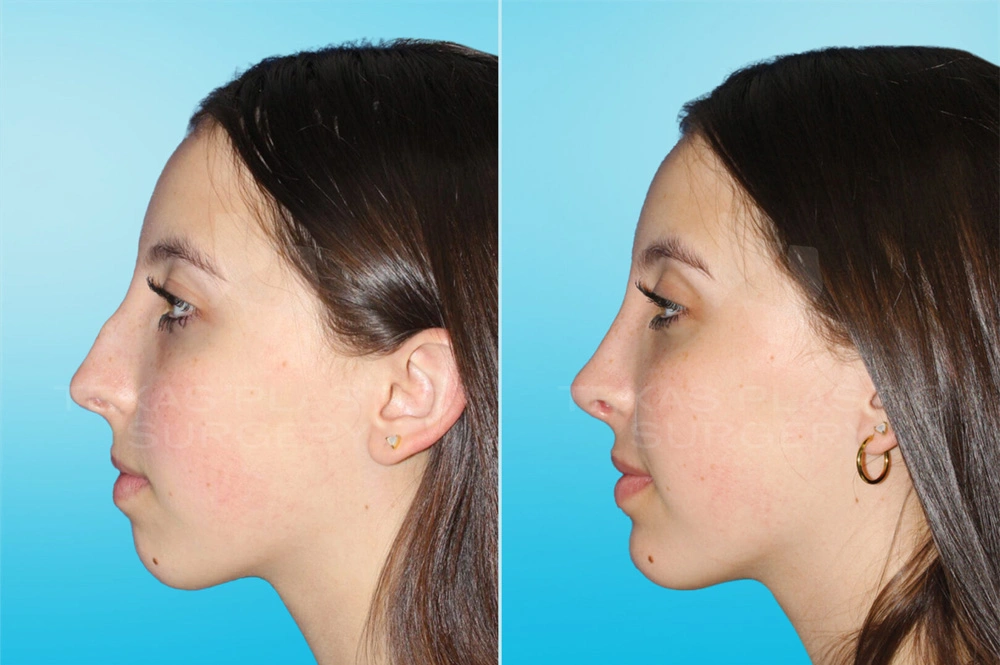 Real Patient results in San Antonio, TX Performed by Texas Plastic Surgery