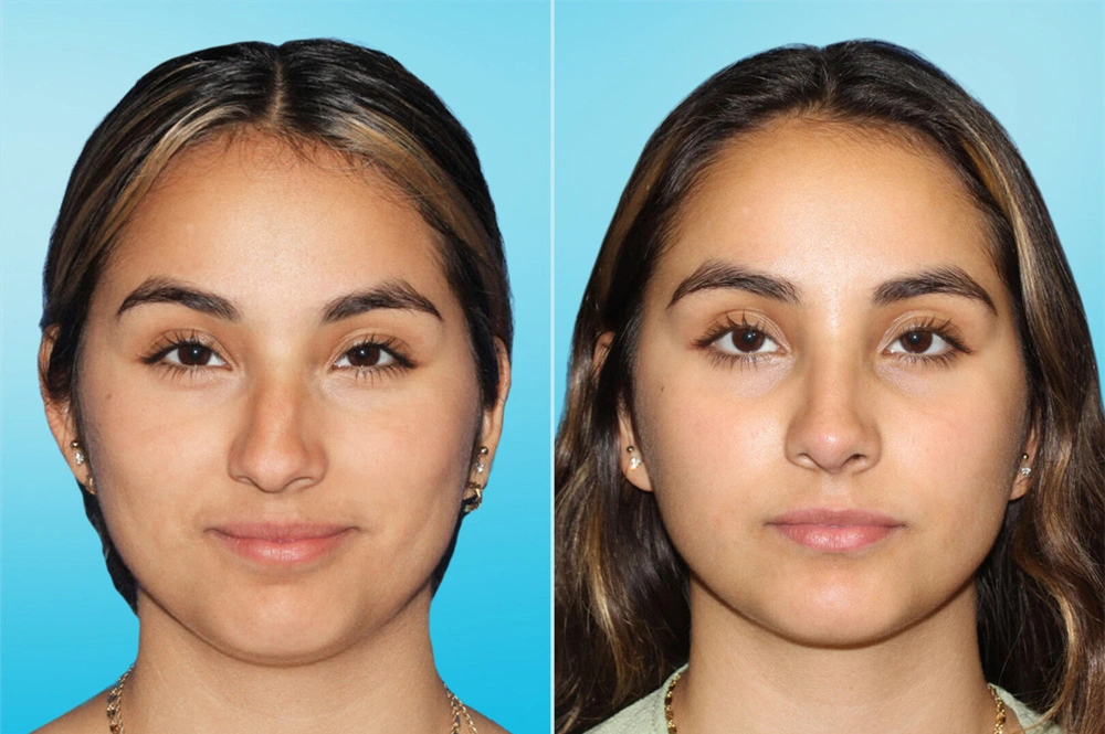 Real Patient results in San Antonio, TX Performed by Texas Plastic Surgery