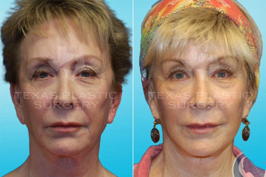 Real Patient results in San Antonio, TX Performed by Texas Plastic Surgery