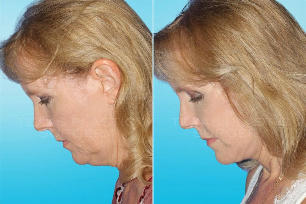 Real Patient results in San Antonio, TX Performed by Texas Plastic Surgery