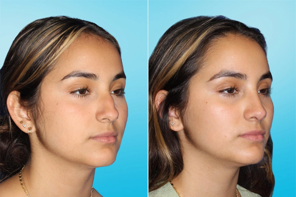 Real Patient results in San Antonio, TX Performed by Texas Plastic Surgery