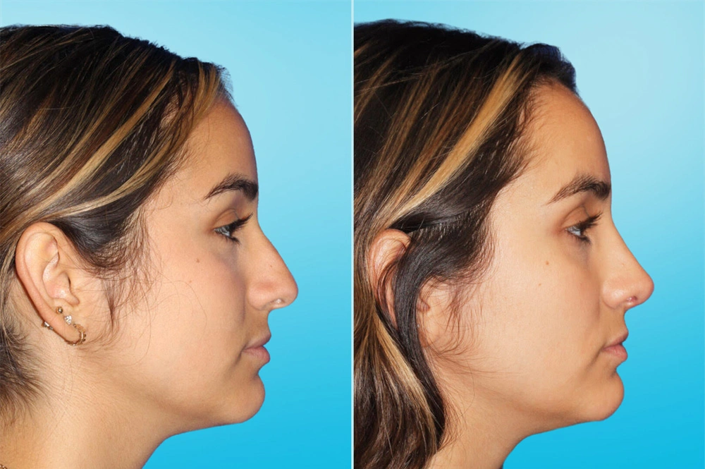 Real Patient results in San Antonio, TX Performed by Texas Plastic Surgery