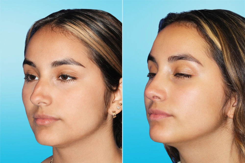 Real Patient results in San Antonio, TX Performed by Texas Plastic Surgery