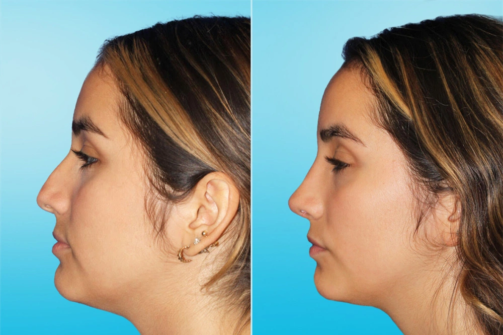 Real Patient results in San Antonio, TX Performed by Texas Plastic Surgery