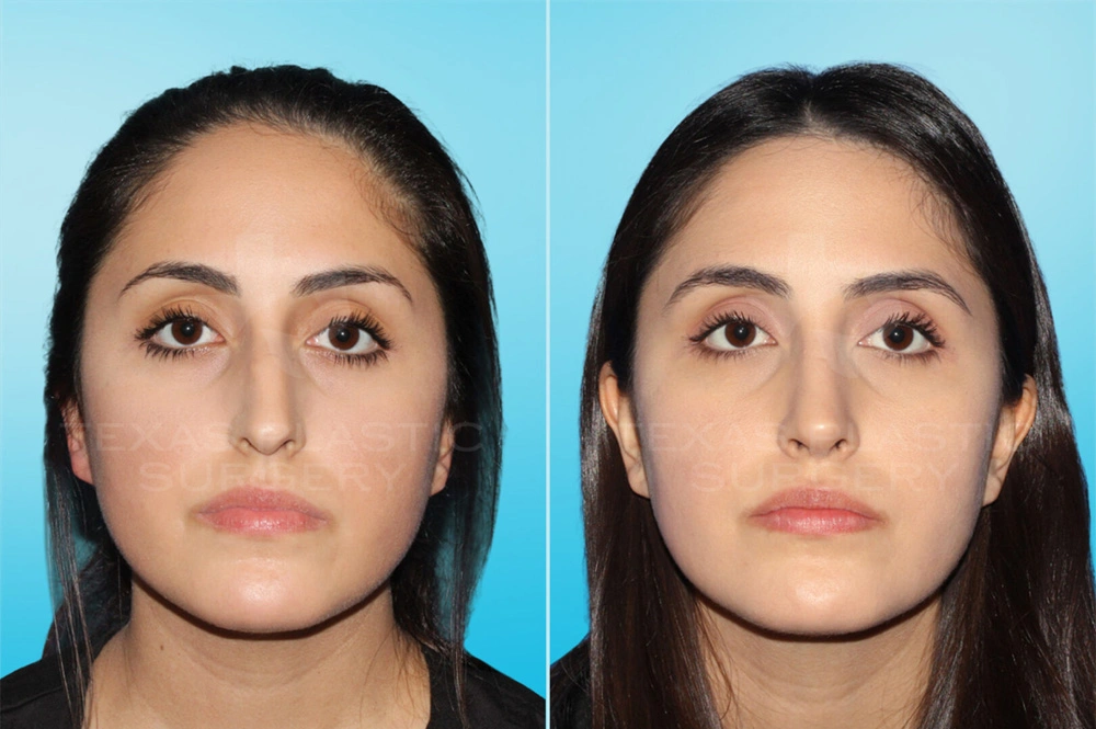 Real Patient results in San Antonio, TX Performed by Texas Plastic Surgery