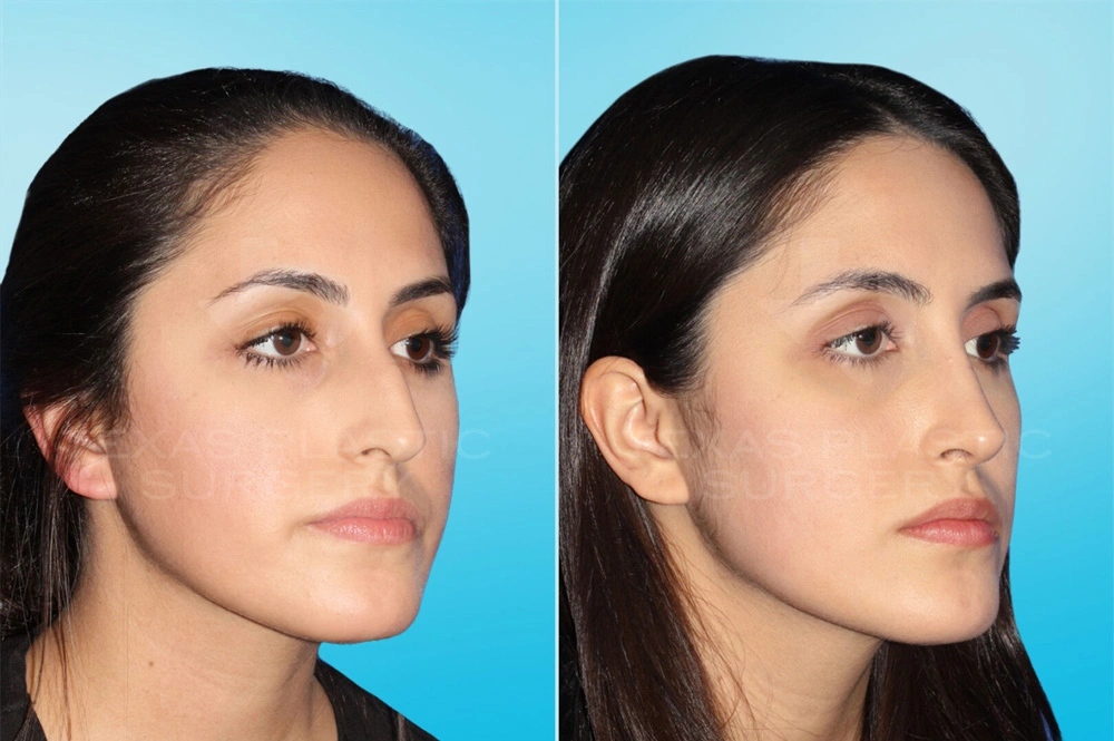 Real Patient results in San Antonio, TX Performed by Texas Plastic Surgery