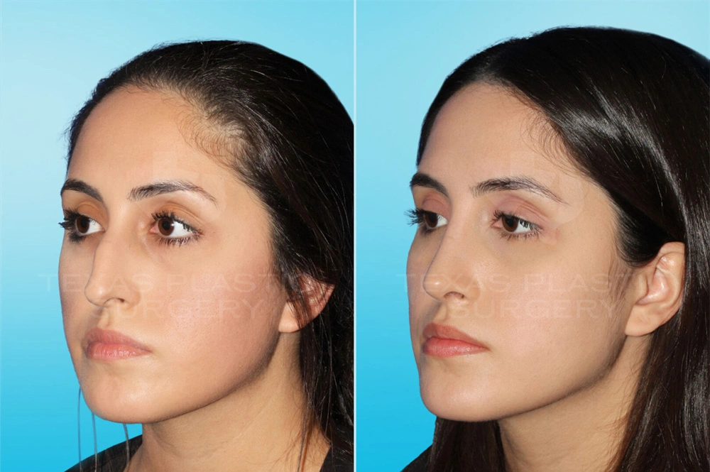 Real Patient results in San Antonio, TX Performed by Texas Plastic Surgery