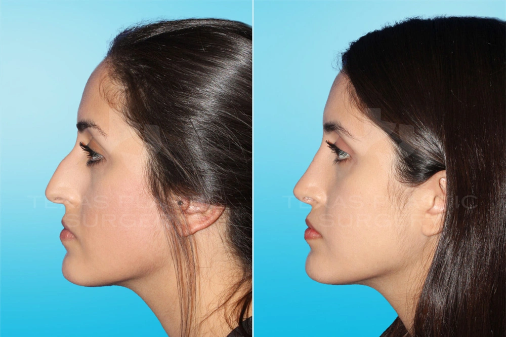 Real Patient results in San Antonio, TX Performed by Texas Plastic Surgery