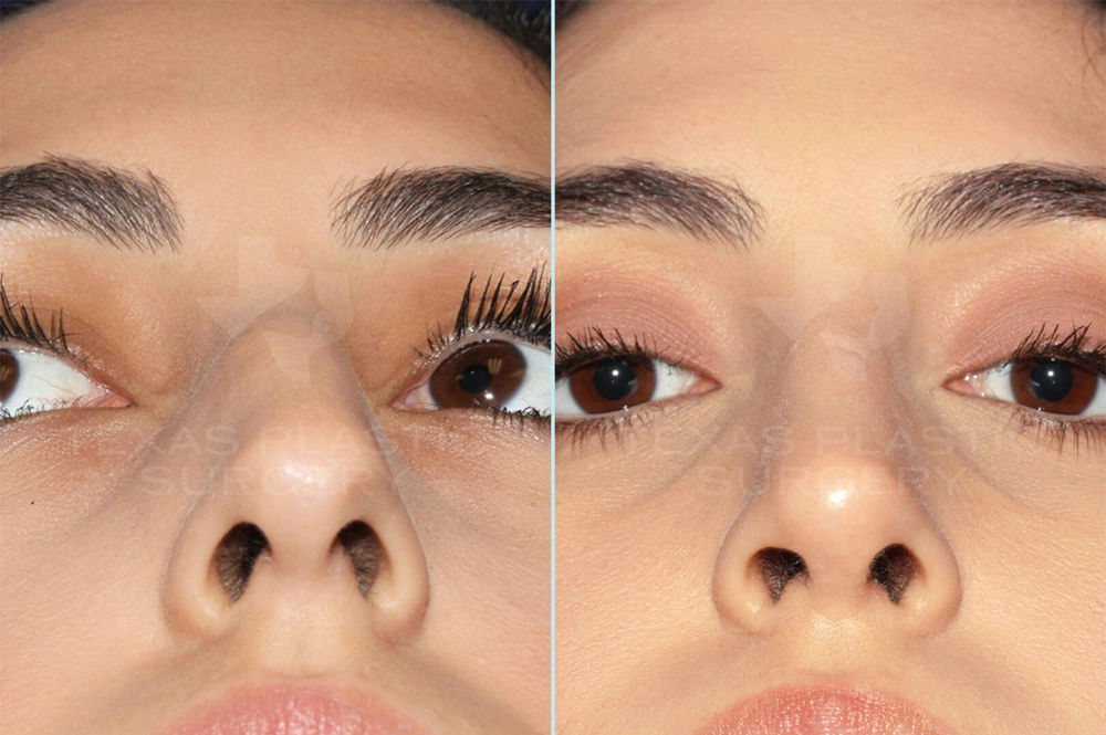 Real Patient results in San Antonio, TX Performed by Texas Plastic Surgery