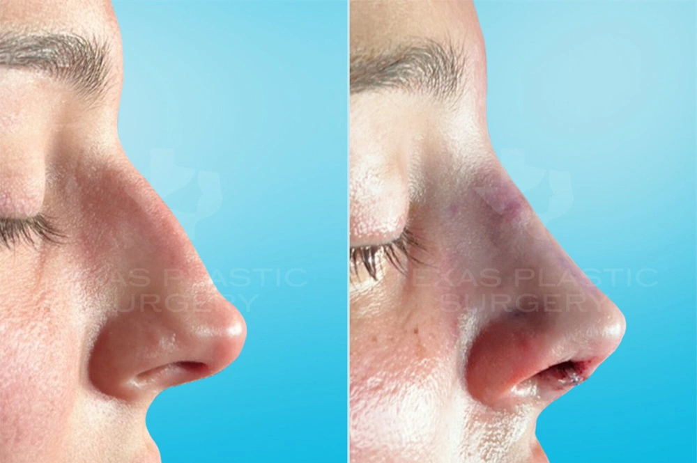 Real Patient results in San Antonio, TX Performed by Texas Plastic Surgery