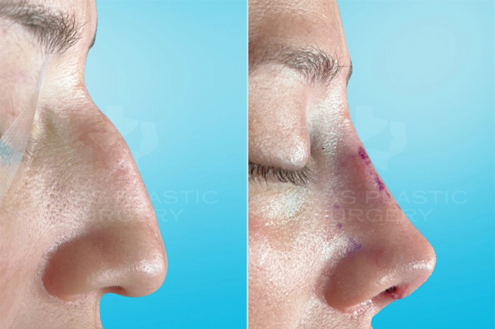 Real Patient results in San Antonio, TX Performed by Texas Plastic Surgery