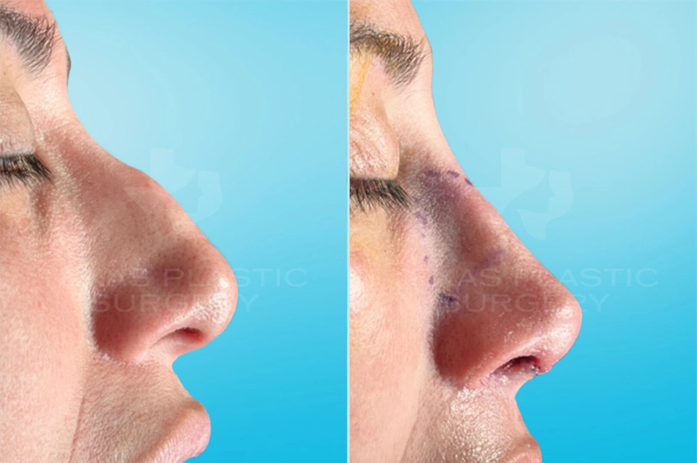 Real Patient results in San Antonio, TX Performed by Texas Plastic Surgery