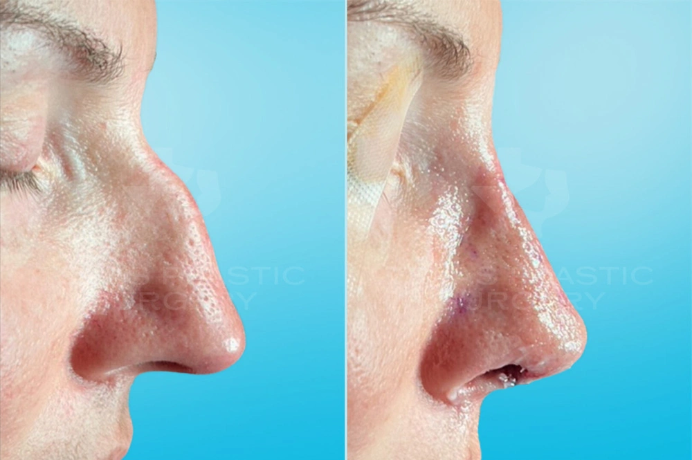 Real Patient results in San Antonio, TX Performed by Texas Plastic Surgery