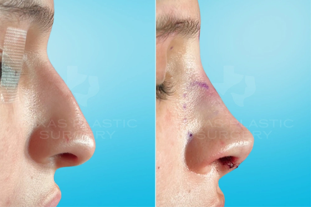 Real Patient results in San Antonio, TX Performed by Texas Plastic Surgery