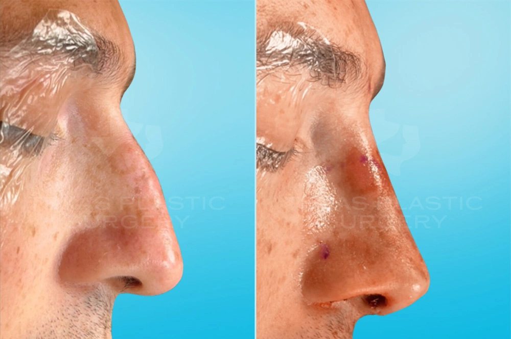 Real Patient results in San Antonio, TX Performed by Texas Plastic Surgery