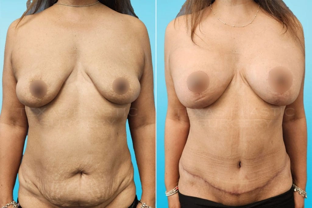 Real Patient results in San Antonio, TX Performed by Texas Plastic Surgery