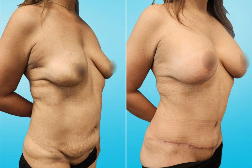 Real Patient results in San Antonio, TX Performed by Texas Plastic Surgery