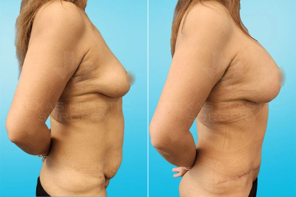 Real Patient results in San Antonio, TX Performed by Texas Plastic Surgery