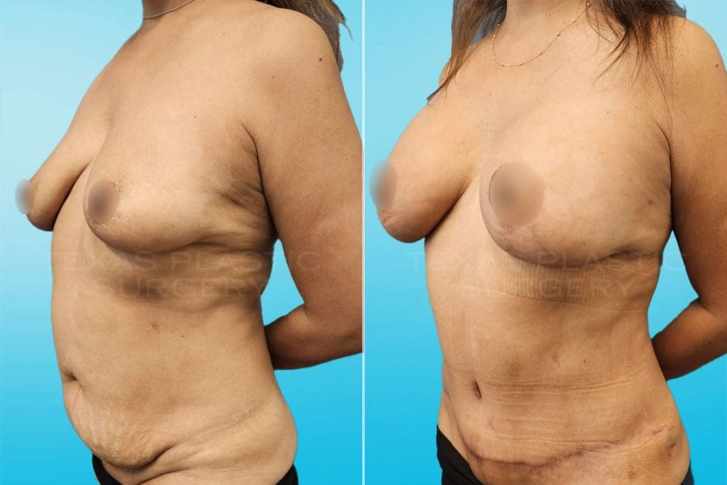 Real Patient results in San Antonio, TX Performed by Texas Plastic Surgery