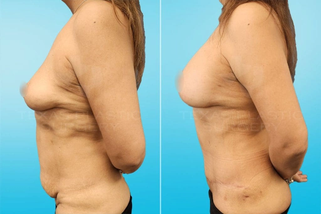 Real Patient results in San Antonio, TX Performed by Texas Plastic Surgery