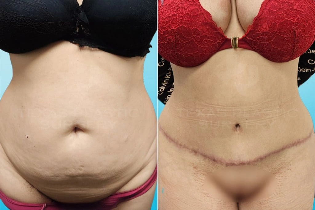 Real Patient results in San Antonio, TX Performed by Texas Plastic Surgery