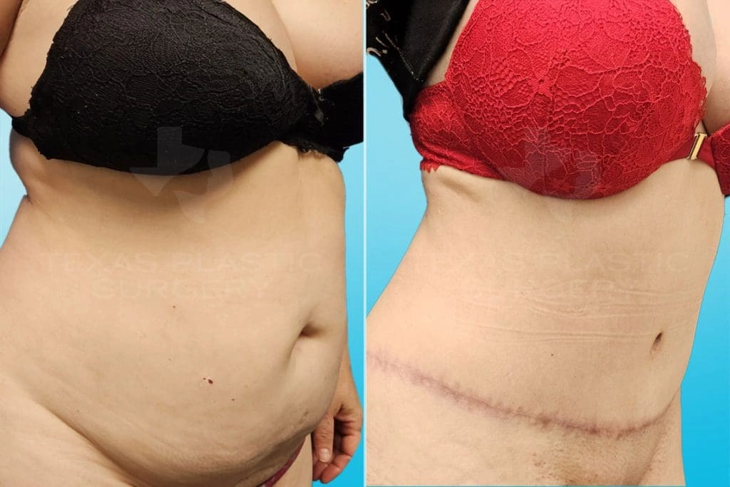 Real Patient results in San Antonio, TX Performed by Texas Plastic Surgery