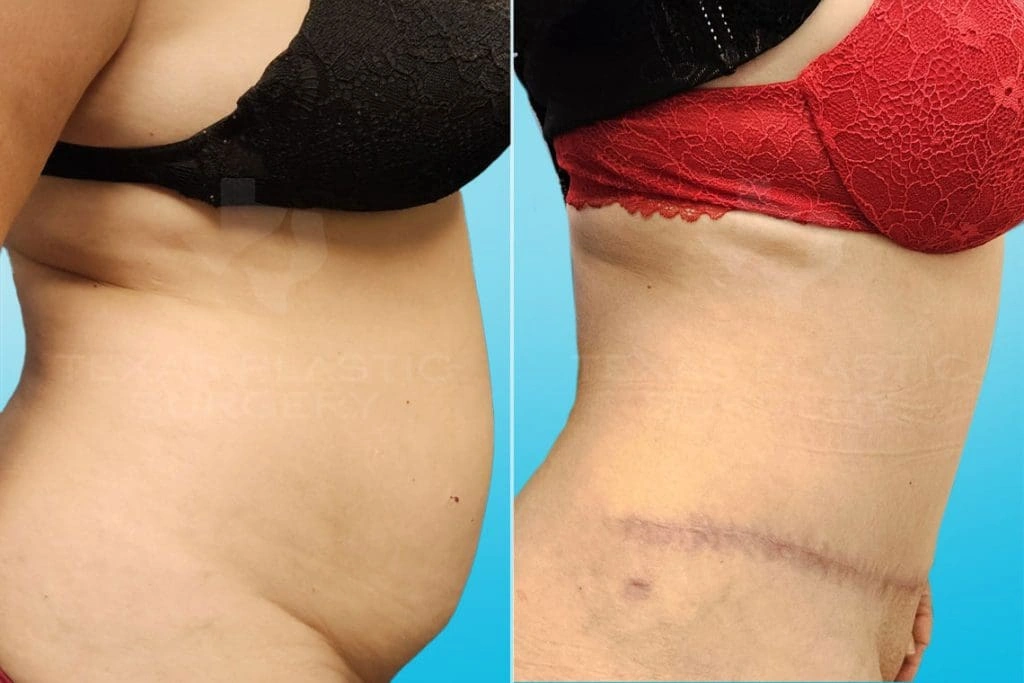 Real Patient results in San Antonio, TX Performed by Texas Plastic Surgery