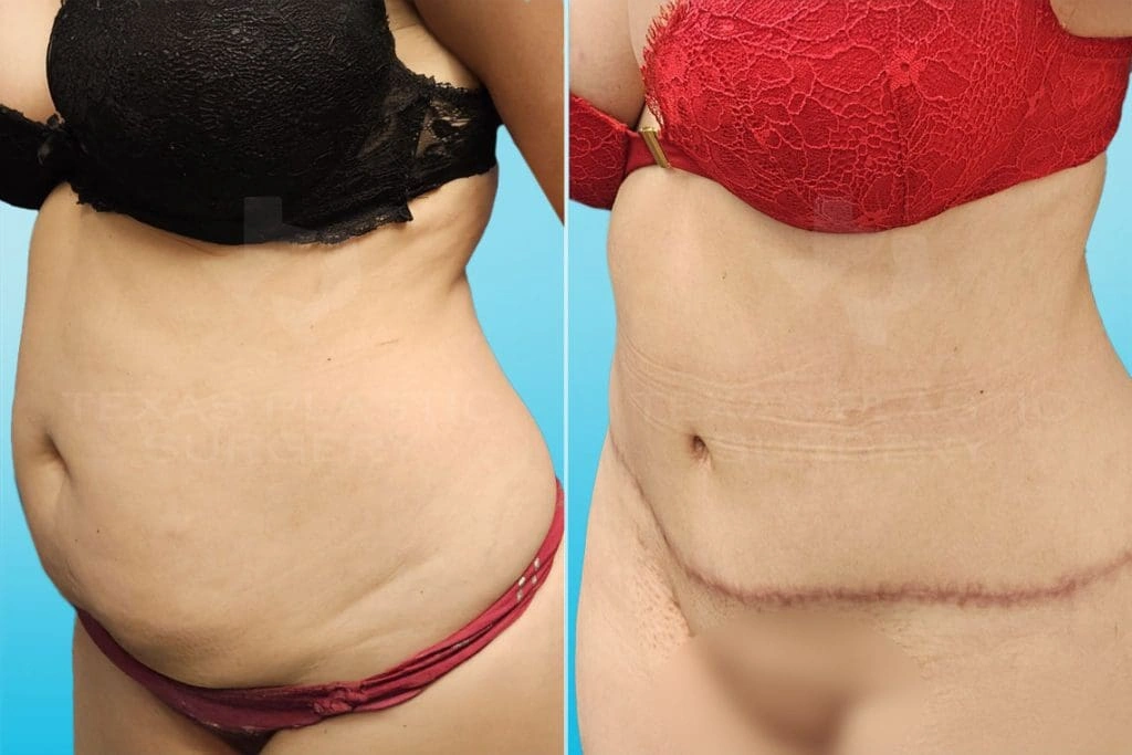 Real Patient results in San Antonio, TX Performed by Texas Plastic Surgery