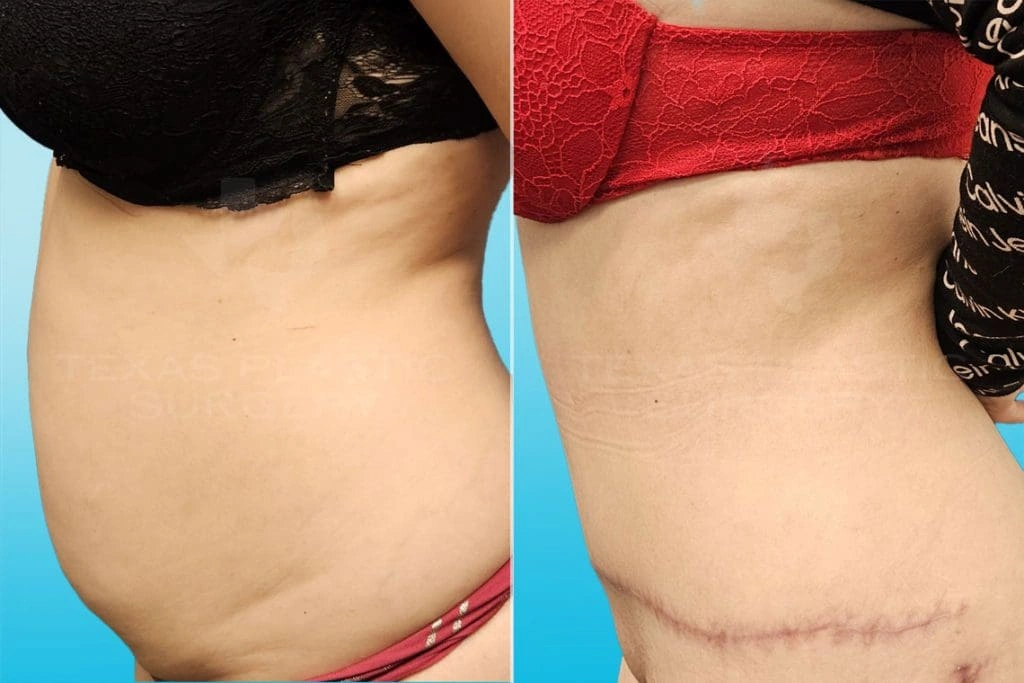 Real Patient results in San Antonio, TX Performed by Texas Plastic Surgery
