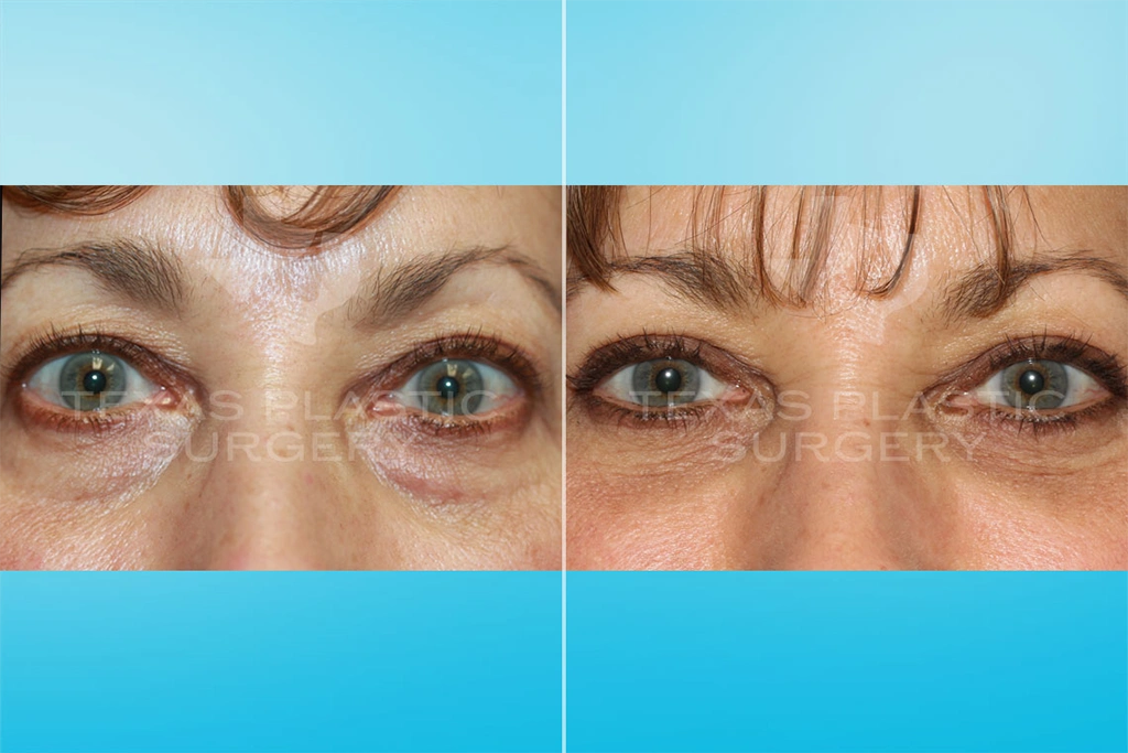 Real Patient results in San Antonio, TX Performed by Texas Plastic Surgery