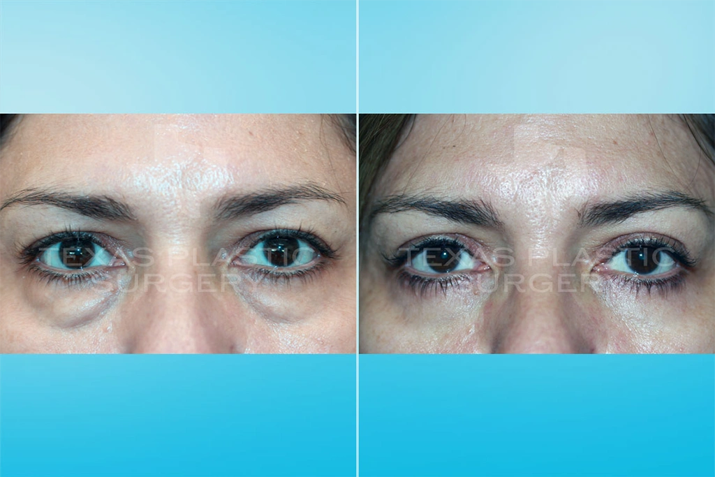 Real Patient results in San Antonio, TX Performed by Texas Plastic Surgery