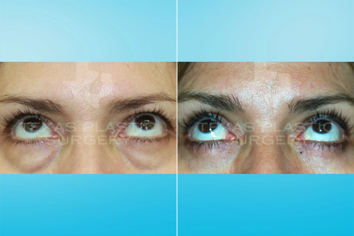 Real Patient results in San Antonio, TX Performed by Texas Plastic Surgery