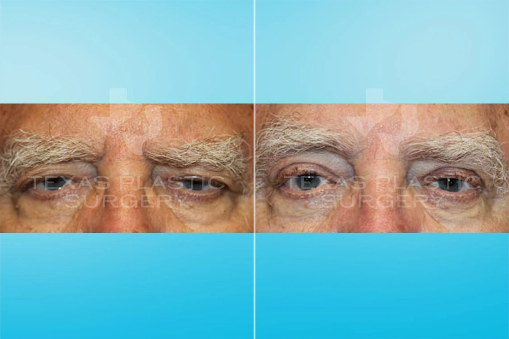 Real Patient results in San Antonio, TX Performed by Texas Plastic Surgery