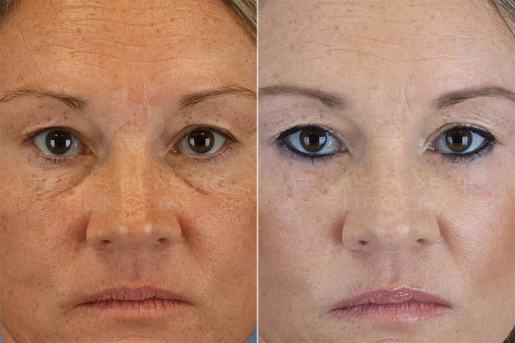 Real Patient results in San Antonio, TX Performed by Texas Plastic Surgery