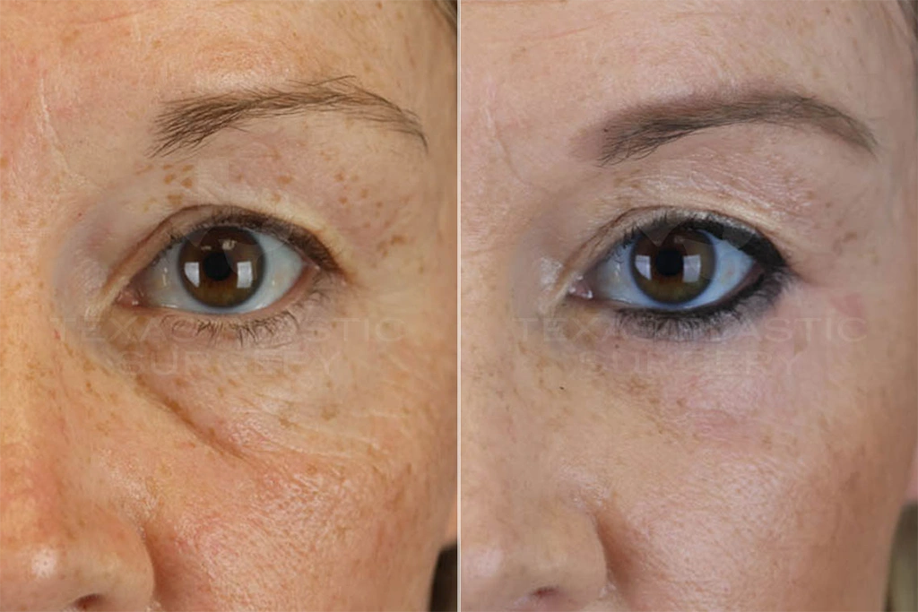 Real Patient results in San Antonio, TX Performed by Texas Plastic Surgery