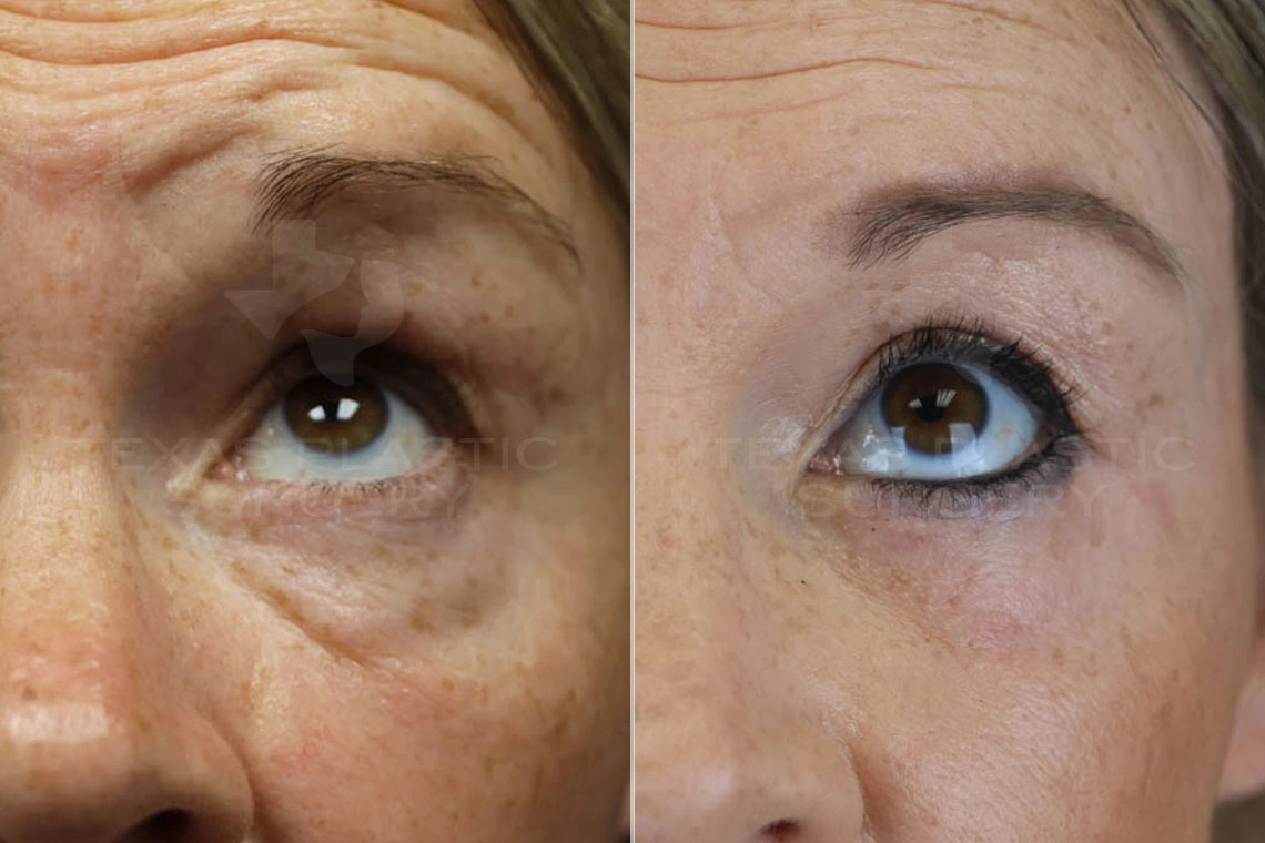 Real Patient results in San Antonio, TX Performed by Texas Plastic Surgery