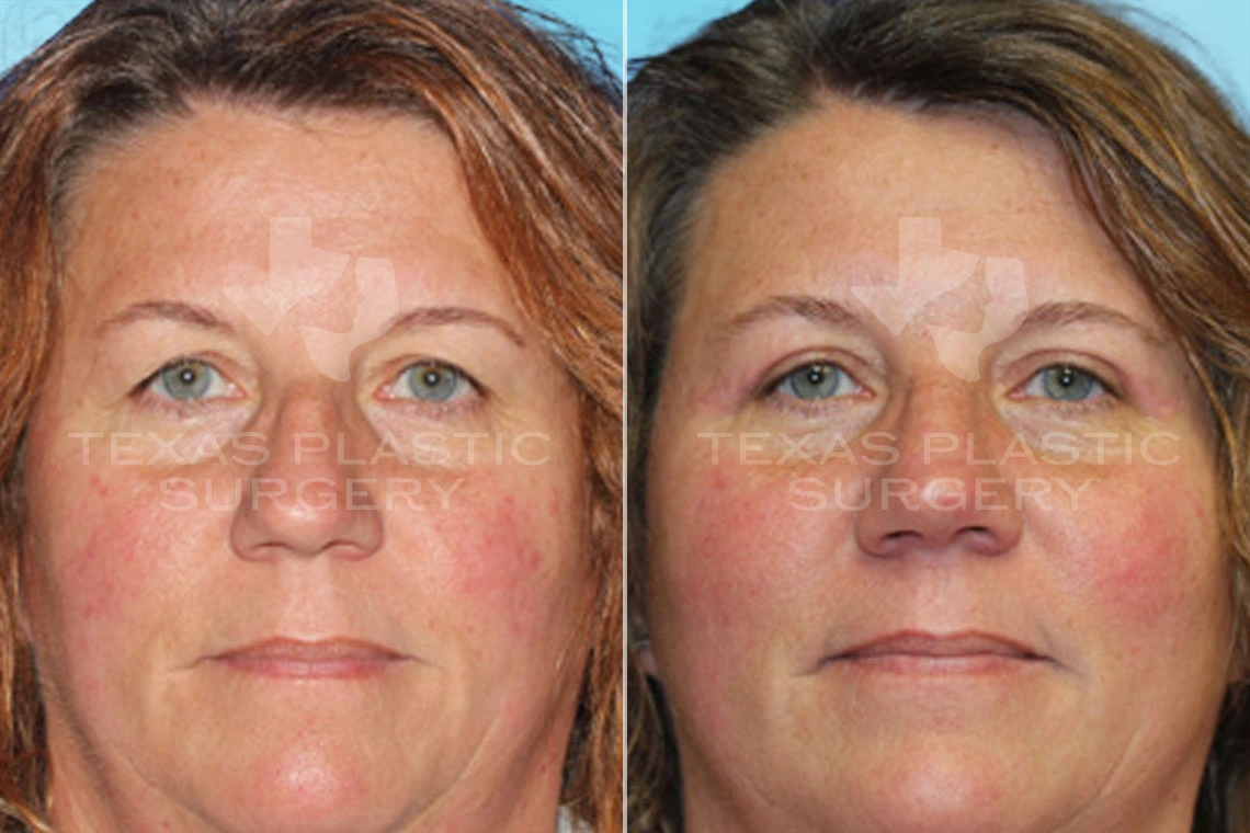 Real Patient results in San Antonio, TX Performed by Texas Plastic Surgery