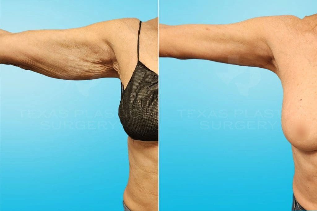 Real Patient results in San Antonio, TX Performed by Texas Plastic Surgery