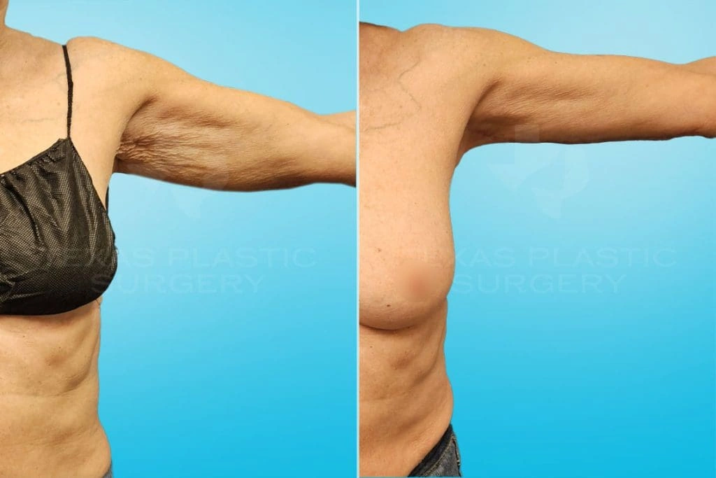 Real Patient results in San Antonio, TX Performed by Texas Plastic Surgery