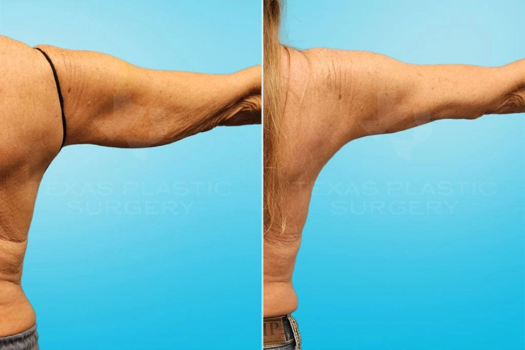 Real Patient results in San Antonio, TX Performed by Texas Plastic Surgery