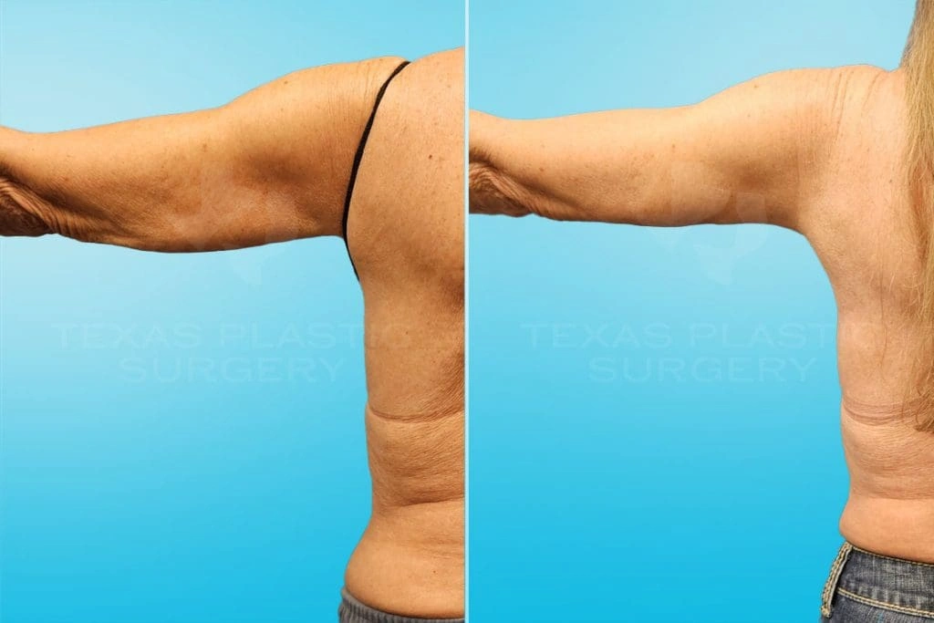 Real Patient results in San Antonio, TX Performed by Texas Plastic Surgery